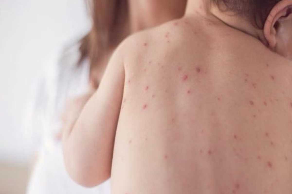 खसरा: रोकी जा सकने वाली घातक बीमारी