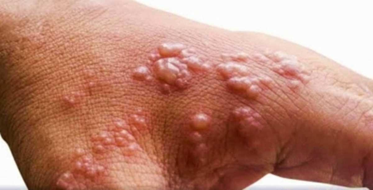 दिल्ली: देश की राजधानी में मंकीपॉक्स का पांचवां मामला आया सामने