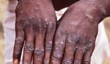 ब्रिटेन में मंकीपॉक्स के मामले 500 के पार
