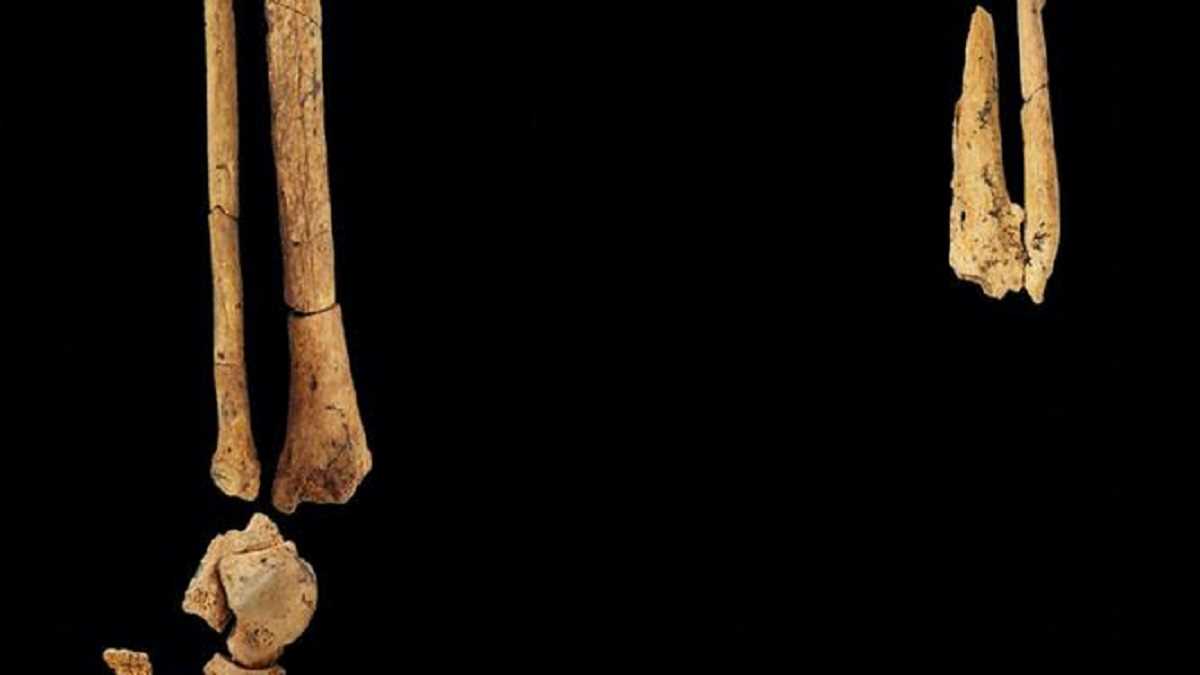 31,000 साल पहले भी हाथ-पांव काट कर जान बचाई जाती थी 31,000 साल पहले भी हाथ-पांव काट कर जान बचाई जाती थी