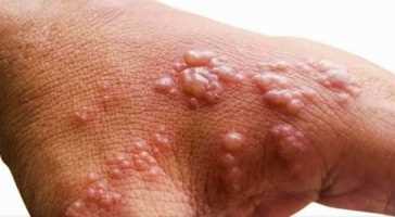 मंकीपॉक्स के खिलाफ सिंगापुर एमओएच ने अभी टीकाकरण की सिफारिश नहीं की : स्वास्थ्य मंत्री