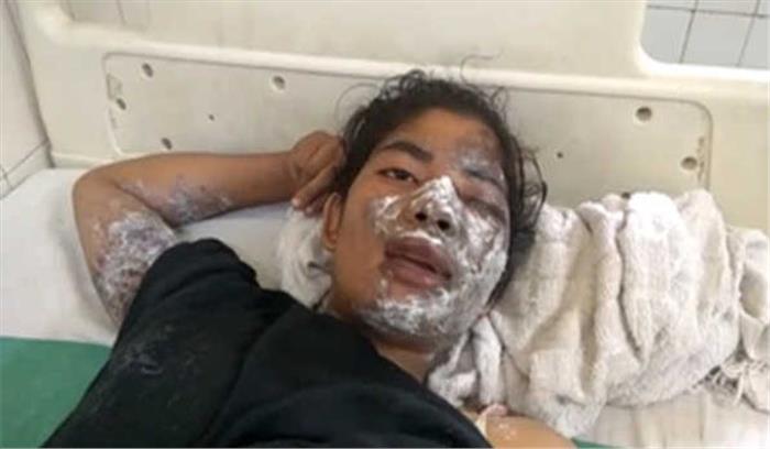 ऐसिड हमले में युवती झुलसी ऐसिड हमले में युवती झुलसी