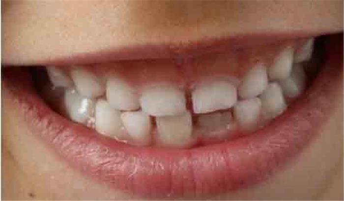 चेन्नई में डॉक्टरों ने निकाले 7 साल के बच्चे के मुंह से 526 दांत