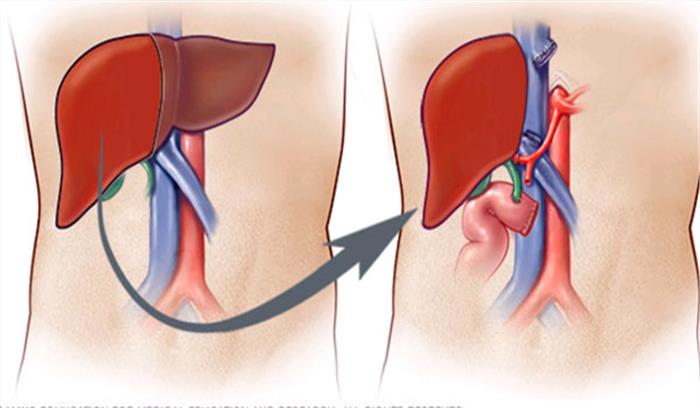 तीन वर्षीय बच्ची का असंगत ब्लड ग्रुप में किया सफल किडनी ट्रांस्प्लांट