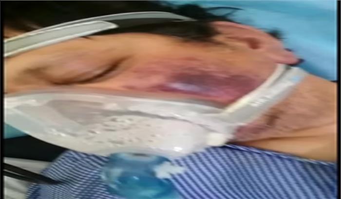 जम्मू-कश्मीर में ब्लैक फंगस से दूसरी मौत, 8 संदिग्ध मरीजों का चल रहा इलाज