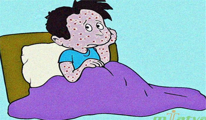 अत्यधिक संक्रामक बीमारी है चिकन पॉक्स