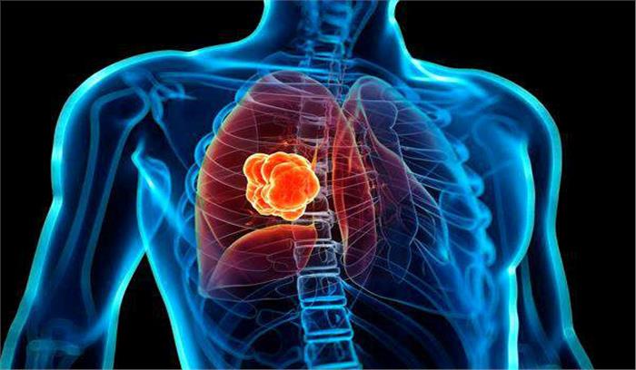 फेफड़े का सबसे बड़ा ह्यूमन इमेज, बना विश्व रिकार्ड