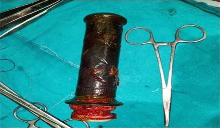 मप्र : महिला के गर्भाशय से बाइक के हैंडिल का हिस्सा निकाला गया