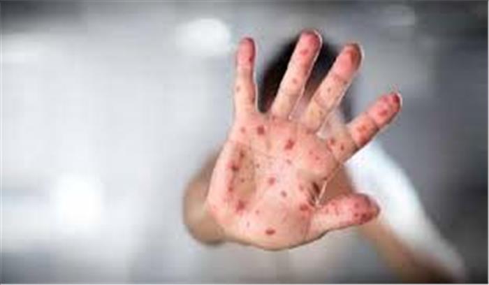 फिलीपींस में 26 लाख बच्चों को खसरे का प्रकोप