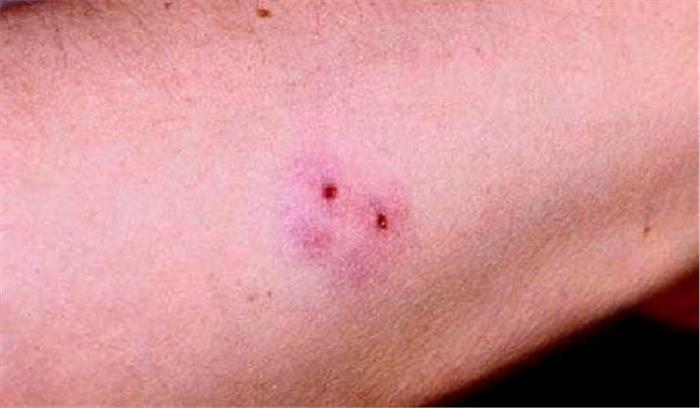 सर्पदंश से भाई की मौत,बहन गंभीर 