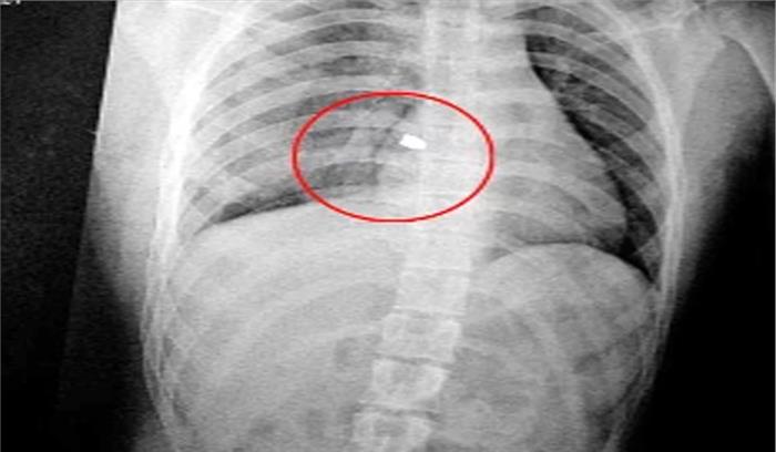 22 साल से शरीर में धंसी है गोली