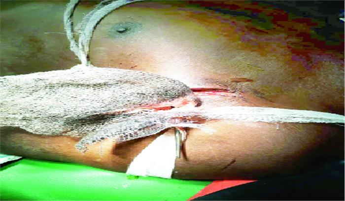 सीने के आर-पार घुसा तीर आपरेशन के बाद निकाला