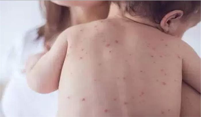  यूपी: खसरा से पीड़ित बच्चों की संख्या बढ़ी