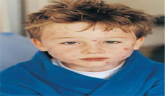 अंचल में चिकनपाक्स का प्रकोप