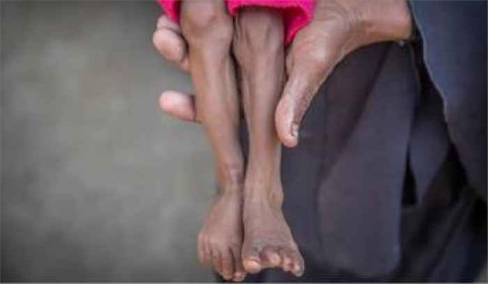 यमन में अत्याधिक कुपोषण से 85 हजार बच्चों की मौत हुई : धर्मार्थ संगठन