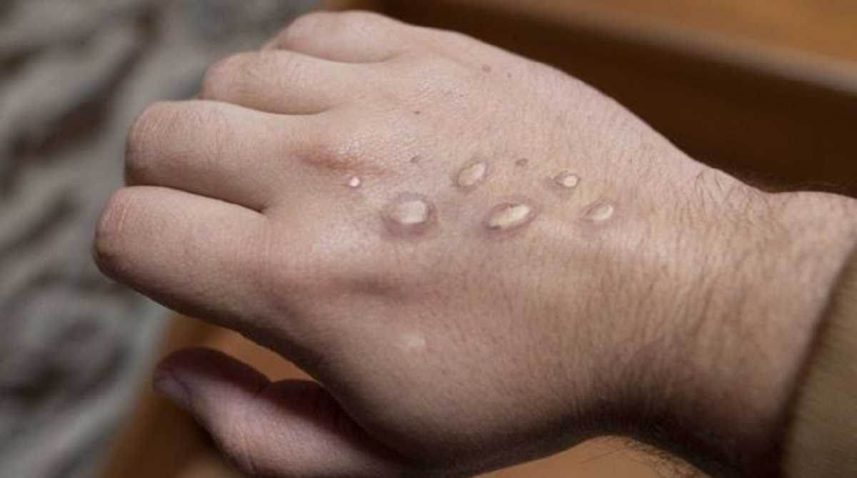 मंकीपॉक्स से बचने के लिए सेक्स पार्टनर कम करने की सलाह