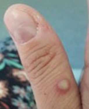 झारखंड में मिला मंकीपाक्स का मरीज, सात वर्षीय बच्ची में दिखे लक्षण, गढ़वा सदर अस्पताल में भर्ती