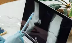 भारतीय वैज्ञानिकों की बड़ी उपलब्धि, शुरुआती हड्डी कैंसर का पता लगाएगा नया उपकरण