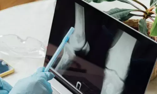 भारतीय वैज्ञानिकों की बड़ी उपलब्धि, शुरुआती हड्डी कैंसर का पता लगाएगा नया उपकरण