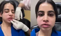 उर्फी जावेद के होंठ और चेहरे को क्या हुआ?, वीडियो देखकर फैंस हैरान