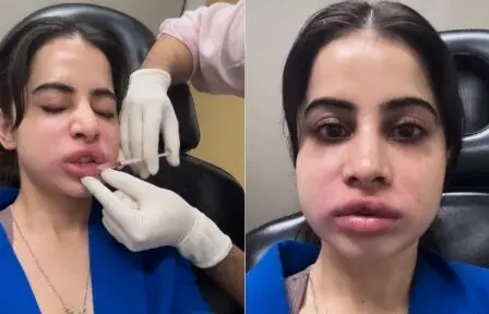 उर्फी जावेद के होंठ और चेहरे को क्या हुआ?, वीडियो देखकर फैंस हैरान