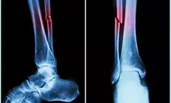 एनआईटी राउरकेला का अध्ययन अस्थि पुनर्जनन तकनीक को बढ़ावा देगा