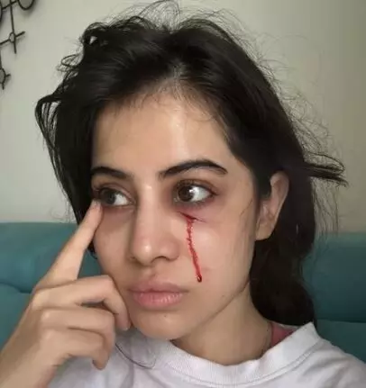 उर्फी जावेद को लगी चोट, चेहरे से बहता दिखा खून