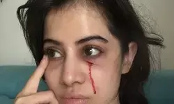 उर्फी जावेद को लगी चोट, चेहरे से बहता दिखा खून