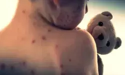 खसरे की चपेट में नामीबिया का उत्तर-पश्चिमी क्षेत्र, सरकार ने जारी किए दिशा निर्देश