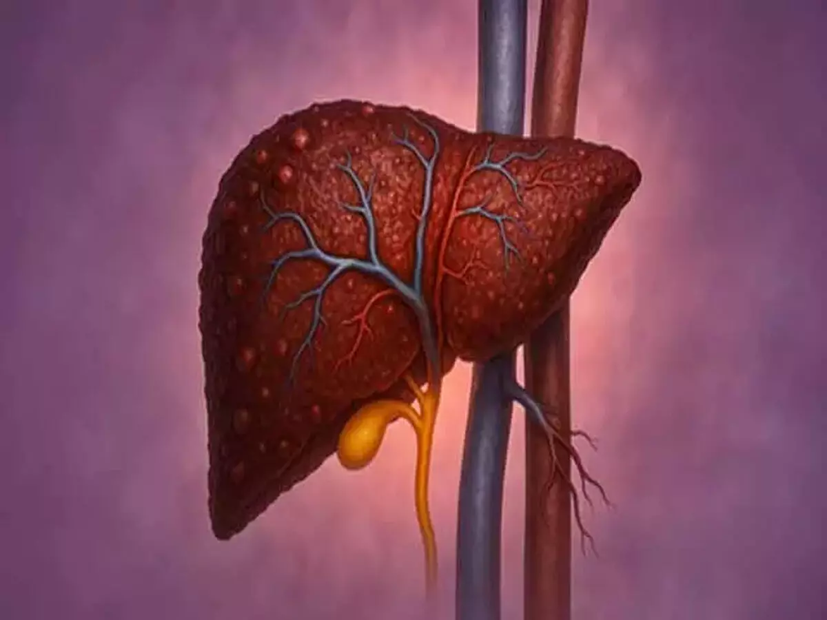 फैटी लिवर चुपचाप शरीर को पहुंचाता है नुकसान! आयुर्वेद से जानें बचाव के उपाय
