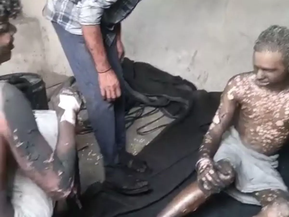 मुरैना फैक्ट्री में गैस पाइप फटने से हादसा, तीन मजदूर गंभीर रूप से झुलसे