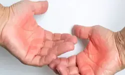 जलने से होने वाले जख्म से तुरंत राहत देंगे घरेलू नुस्खे, त्वचा पर नहीं पड़ेगा दाग