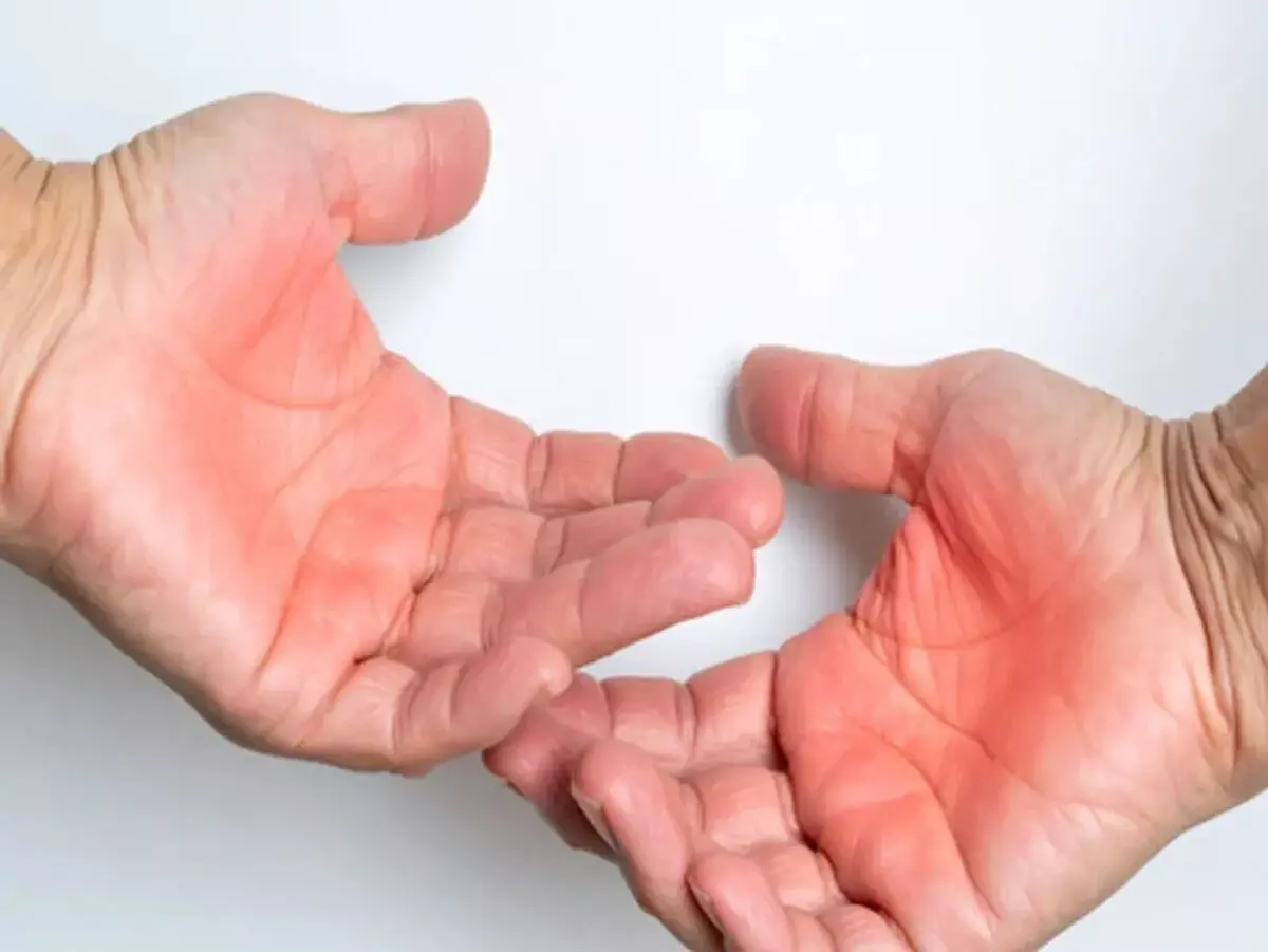 जलने से होने वाले जख्म से तुरंत राहत देंगे घरेलू नुस्खे, त्वचा पर नहीं पड़ेगा दाग जलने से होने वाले जख्म से तुरंत राहत देंगे घरेलू नुस्खे, त्वचा पर नहीं पड़ेगा दाग