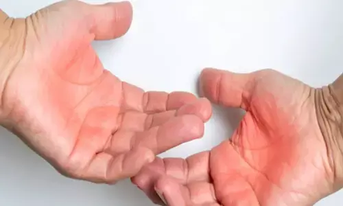 जलने से होने वाले जख्म से तुरंत राहत देंगे घरेलू नुस्खे, त्वचा पर नहीं पड़ेगा दाग जलने से होने वाले जख्म से तुरंत राहत देंगे घरेलू नुस्खे, त्वचा पर नहीं पड़ेगा दाग