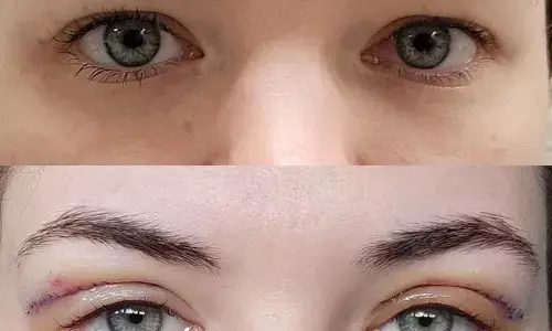 रोशनी का इंतजार लंबा होता जा रहा है जम्मू कश्मीर में क्योंकि आंखों का दान बहुत कम