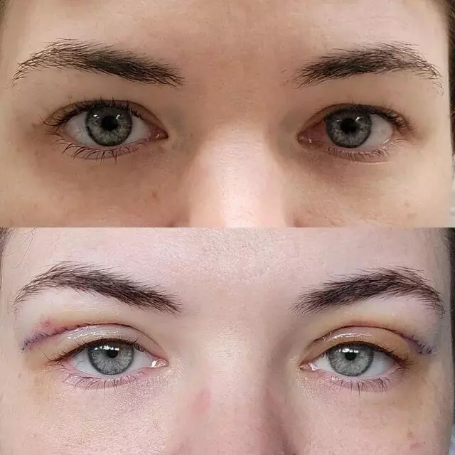 रोशनी का इंतजार लंबा होता जा रहा है जम्मू कश्मीर में क्योंकि आंखों का दान बहुत कम