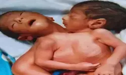 दो सिर, दो हाथ और चार पैर लेकिन दिल एक... एक ऐसा जन्म, जिसने सबको चौंका दिया दो सिर, दो हाथ और चार पैर लेकिन दिल एक... एक ऐसा जन्म, जिसने सबको चौंका दिया