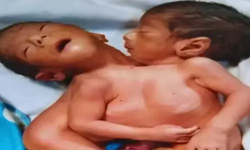 दो सिर, दो हाथ और चार पैर लेकिन दिल एक... एक ऐसा जन्म, जिसने सबको चौंका दिया 