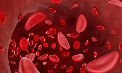 सिकल सेल रोग: विश्व सिकल दिवस, सिकल सेल : समानता का हकदार सिकल सेल रोग: विश्व सिकल दिवस, सिकल सेल : समानता का हकदार